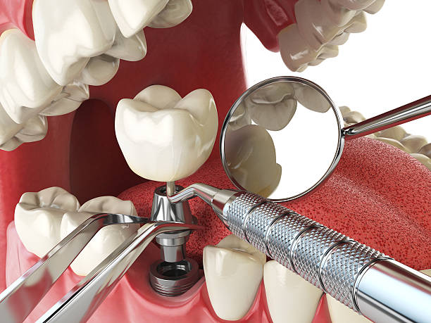 Best Emergency Wisdom Teeth Removal in Lyons, KS